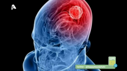 Ανεύρυσμα εγκεφάλου