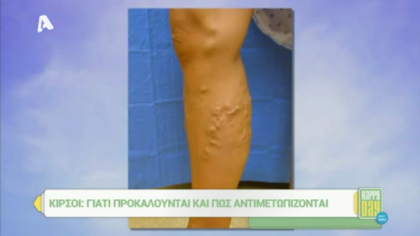 Πώς αντιμετωπίζονται οι κιρσοί