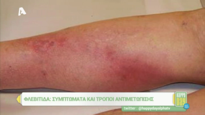 Πώς αντιμετωπίζεται η φλεβίτιδα