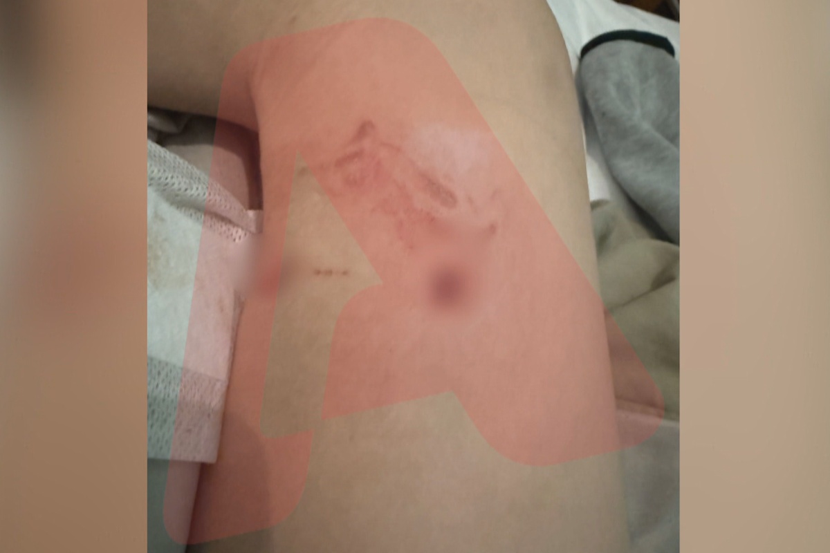 Επίθεση σκύλου σε 12χρονο